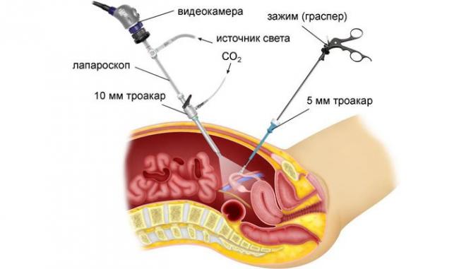 лапароскопическая операция