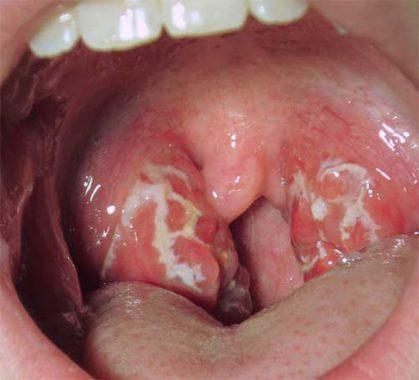 angina-419x380.jpg