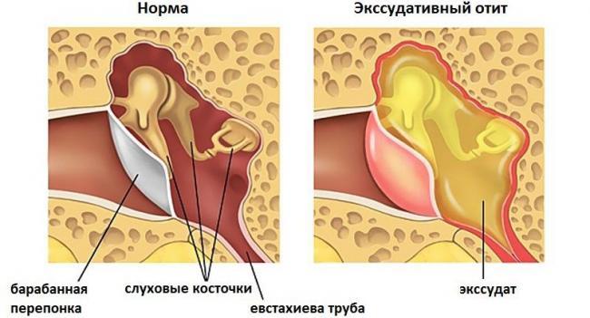 Ekssudativnyj-otit-u-detej-e1513614083829.jpg