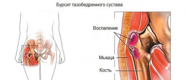 noyushhaya-bol-v-tazobedrennom-sustave-nochyu.jpg