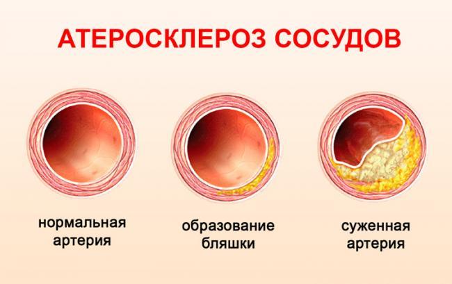 aritmiya-prichiny-lechenie-narodnymi-sredstvami_2.jpg