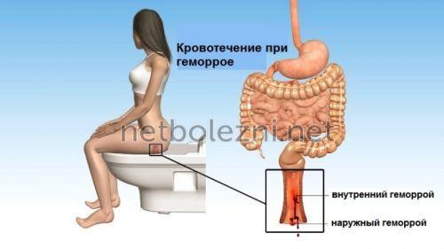 1516646627_krovotechenie-pri-gemorroe.jpg