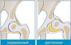 displaziya-tazobedrennyx-sustavov-300x188.jpg