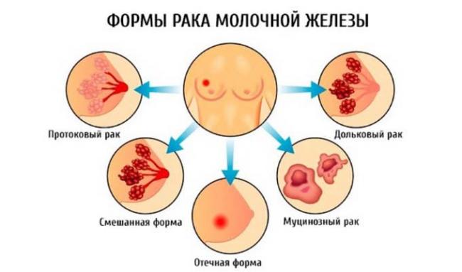 формы рака молочной железы