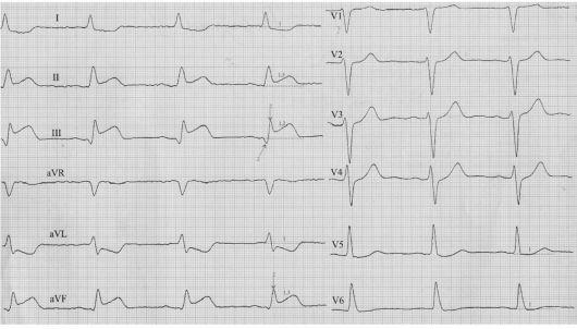 infarkt_na_ekg_ostreishaya.jpeg