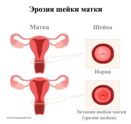 eroziya.jpg