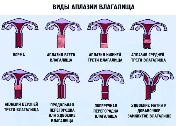 виды аплазии влагалища