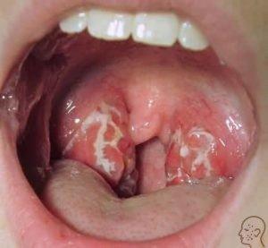 gribok-v-gorle-foto-300x277.jpg