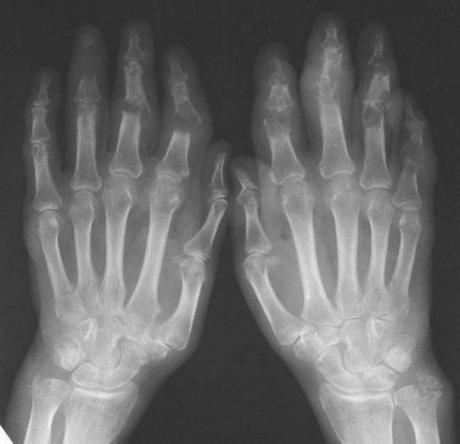 Dieta-pri-psoriaticheskom-artrite-3.jpg