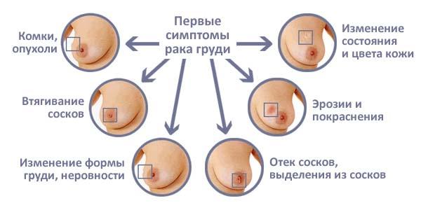 первые симптомы рака груди