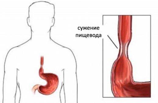 Disfagiya-pishhevoda-simptomy.jpg