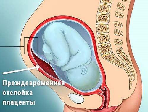 отслойка плаценты на ранних сроках