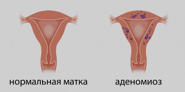 аденомиоз и нормальная матка