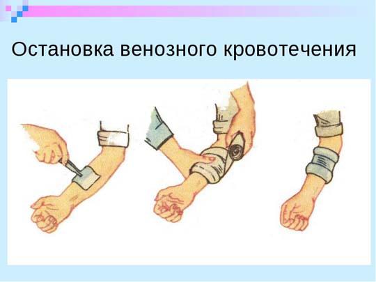 ostanovka-venoznogo-krovotecheniya.jpg