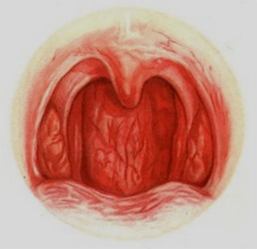 Acute-pharyngitis.jpg