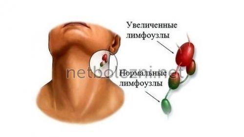 1522621601_kak-vyglyadyat-vospalennye-limfouzly.jpg