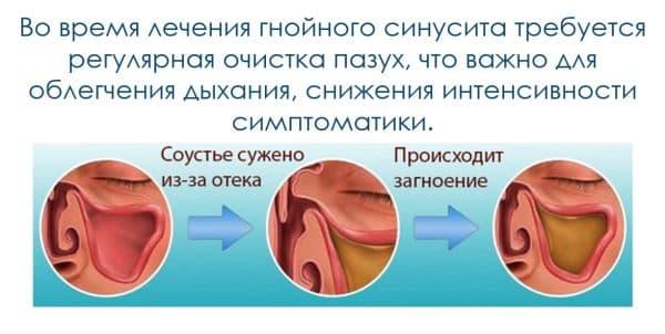 gnoyniy-sinusit-600x302.jpg