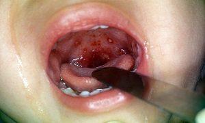gerpesnaya_angina_u_detei-300x180.jpg