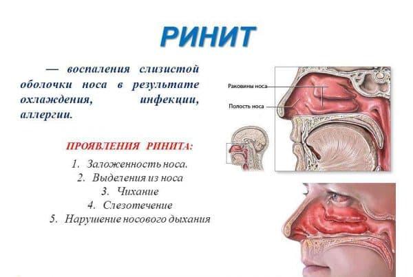 %D0%BE%D1%81%D0%BB%D0%BE%D0%B6%D0%BD%D0%B5%D0%BD%D0%B8%D1%8F-%D0%B7%D0%B0%D0%BB%D0%BE%D0%B6%D0%B5%D0%BD%D0%BD%D0%BE%D1%81%D1%82%D0%B8-%D0%BD%D0%BE%D1%81%D0%B0-600x403.jpg