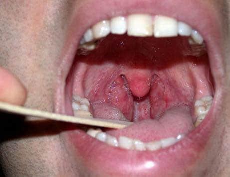 tonzillit_1_13180805.jpg
