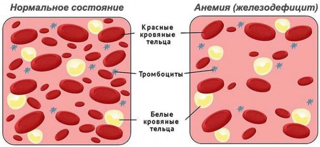 железодефицит
