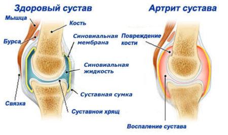 Ris.-2-Artrit-450x267.jpg