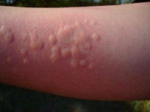 krapivnicta-300x225.jpg