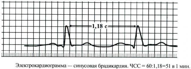sinusovaya-bradikardiya.jpg