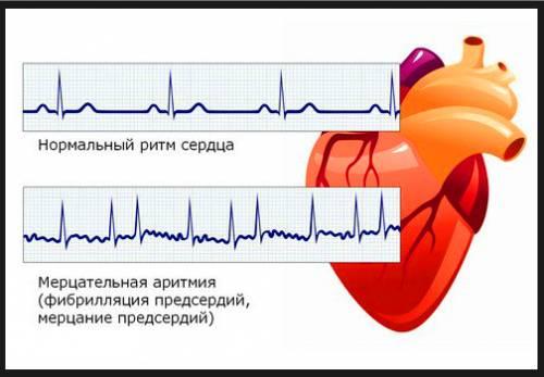 Ekg-mertsatelynoy_500x347.jpg
