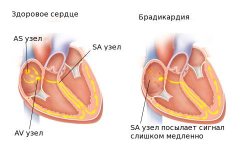 sinusovyj-uzel-serdca.jpg