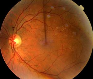 razvitie-retinopatii.jpg
