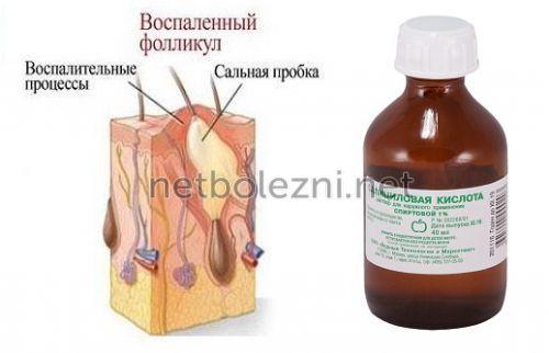 1522619750_salicilovaya-kislota-vospalenie-follikula.jpg