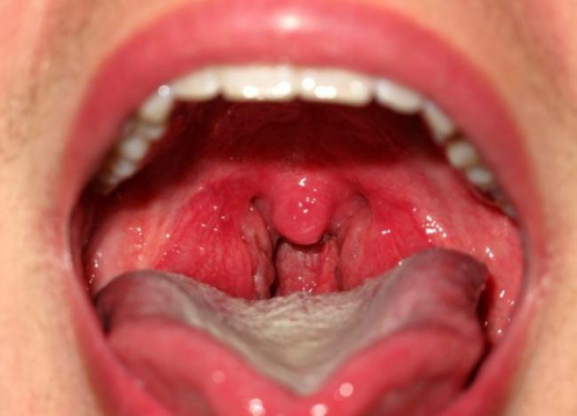 Angina-1-768x555.jpg