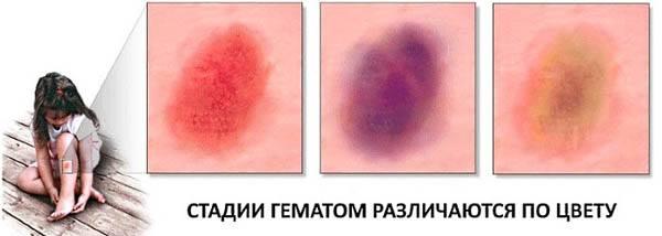lopayutsya-sosudy-na-nogax-prichiny-i-lechenie-9.jpg