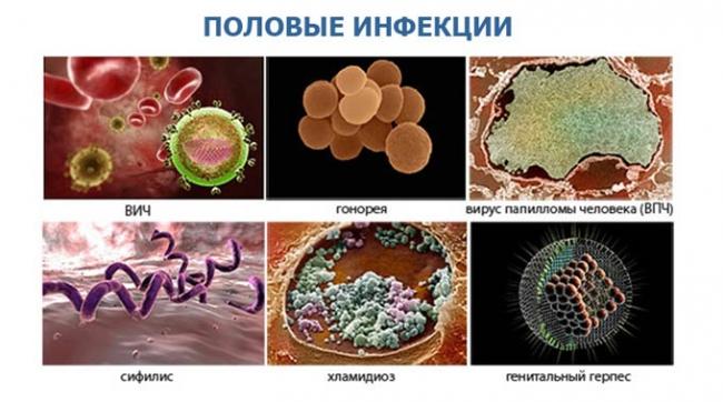 половые инфекции