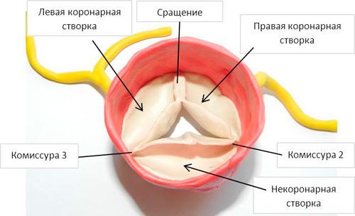 kalcinoz_aortalnogo_klapana_1.jpg