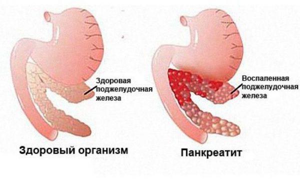 pankreatit-chto-eto-za-zabolevanie-600x359.jpg