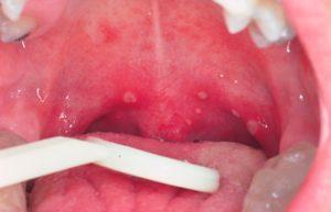 angina-foto-gorla-11-300x193.jpg