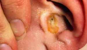 otit-naruzhnogo-uha-simptomy-i-lechenie.jpg