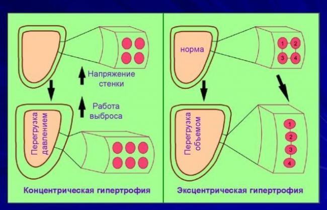 Gipertrofiya-levogo-zheludochka-e1500273044771.jpg