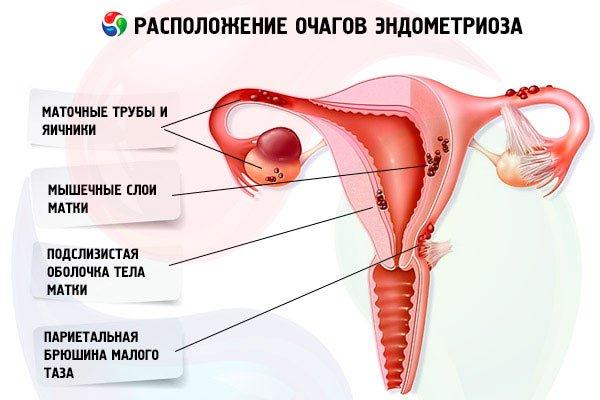 очаги эндометриоза