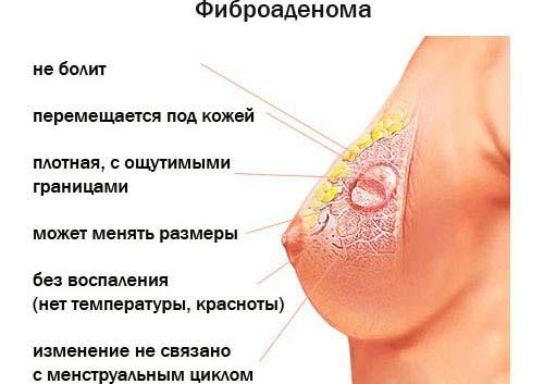 симптомы фиброаденомы