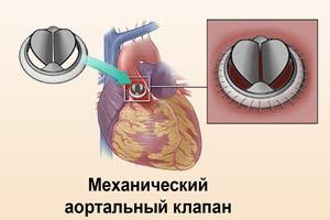 zamena-klapana-serdca_2.jpg