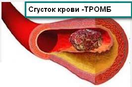 tromb(1).jpg