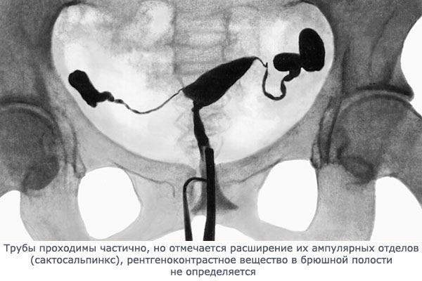 трубы проходимы частично