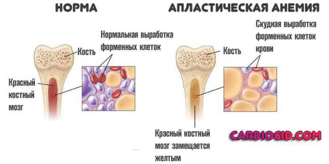 aplasticheskaya-anemiya.jpg