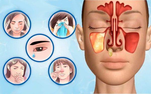 simptomy-gaymorita-600x375.jpg