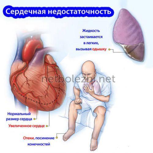 1500020107_serdechnaya-nezhostatochnost-i-odyshka.jpg