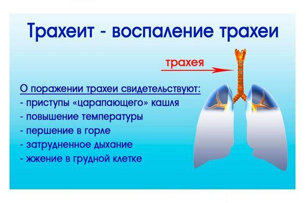 traheidnyj-kashel-1.jpg