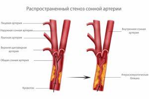 stenoz-sonnoj-arterii-300x199.jpg